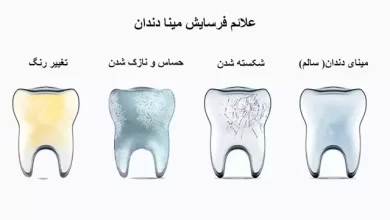 فرسایش مینای دندان