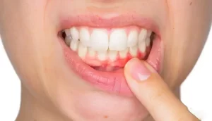 چرک دندان