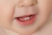 داندان کودک