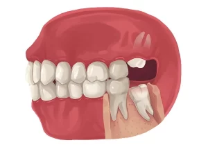 کشیدن دندان عقل هردو دندان