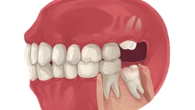 کشیدن دندان عقل هردو دندان